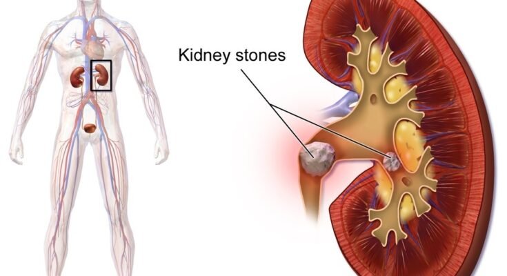 Kidney stone