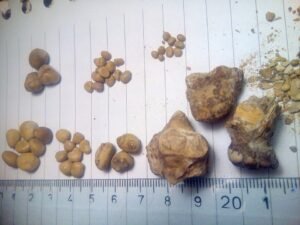 Kidney stones